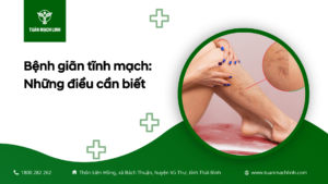 Bệnh giãn tĩnh mạch: Những điều cần biết