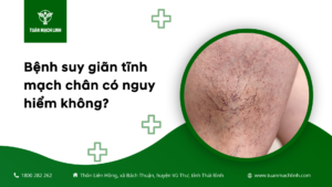 Bệnh suy giãn tĩnh mạch chân có nguy hiểm không?