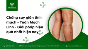 Chứng suy giãn tĩnh mạch - Tuân Mạch Linh - Giải pháp hiệu quả nhất hiện nay