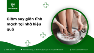 Giảm suy giãn tĩnh mạch tại nhà hiệu quả