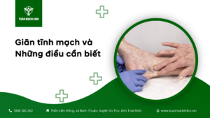 Giãn tĩnh mạch và Những điều cần biết