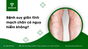 Bệnh suy giãn tĩnh mạch chân có nguy hiểm không?