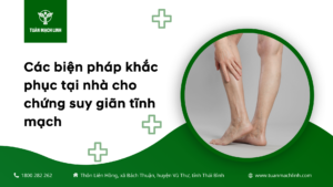 Các biện pháp khắc phục tại nhà cho chứng suy giãn tĩnh mạch