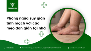 Phòng ngừa suy giãn tĩnh mạch với các mẹo đơn giản tại nhà