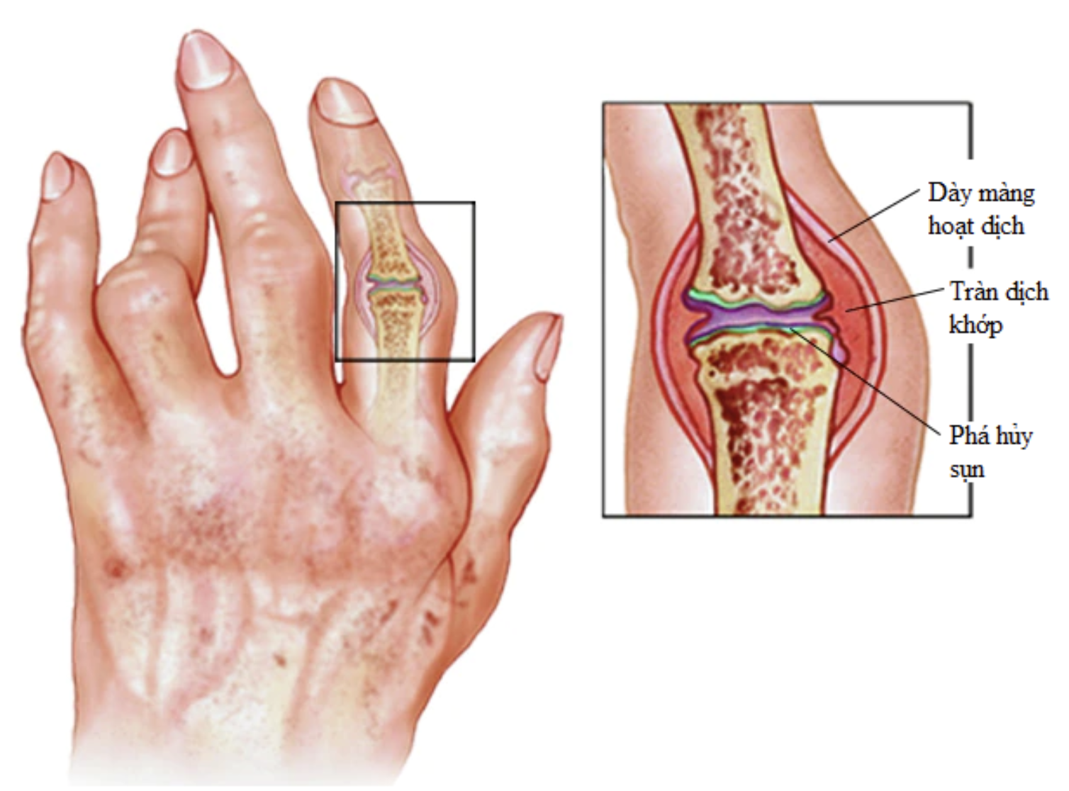 Viêm khớp dạng thấp là bệnh lý viêm mạn tính, ảnh hưởng toàn thân, đặc biệt là gây viêm khớp