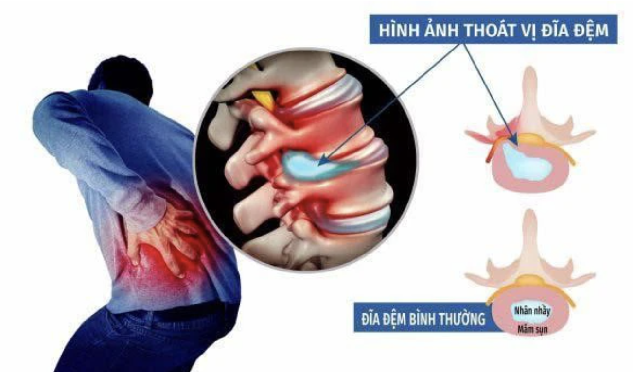 Thoát vị đĩa đệm không điều trị kịp thời có thể dẫn đến mất khả năng vận động (Ảnh minh họa)