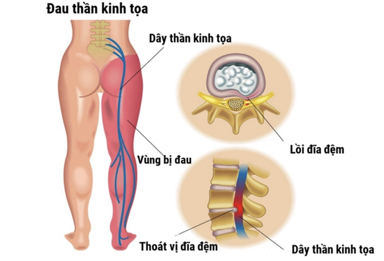 Hình ảnh đau thần kinh tọa.