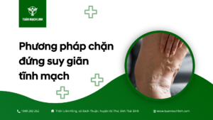 Phương pháp chặn đứng suy giãn tĩnh mạch