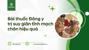 Bài thuốc Đông y trị suy giãn tĩnh mạch chân hiệu quả