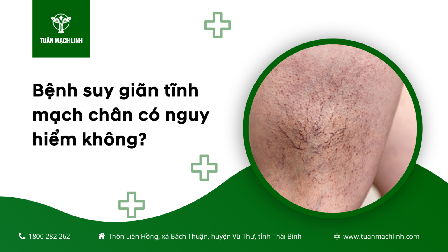 Bệnh suy giãn tĩnh mạch chân có nguy hiểm không?