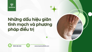 Những dấu hiệu giãn tĩnh mạch và phương pháp điều trị