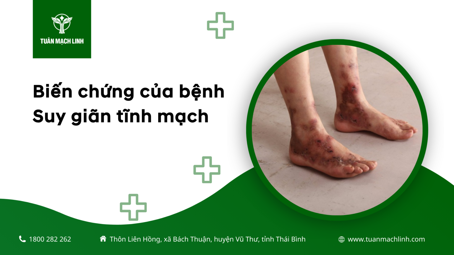 Biến chứng của bệnh Suy giãn tĩnh mạch