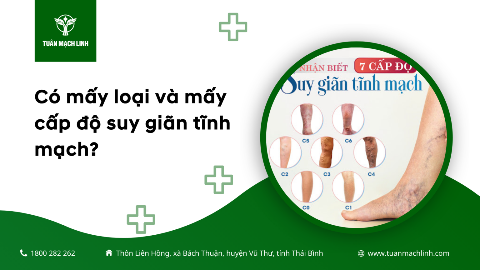 Có mấy loại và mấy cấp độ suy giãn tĩnh mạch?