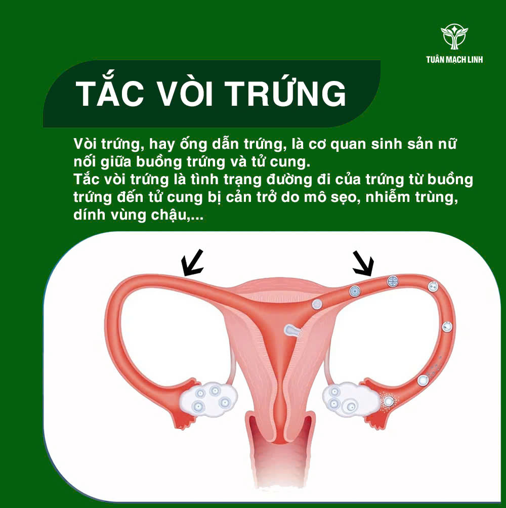 Tắc vòi trứng là gì? Nguyên nhân, triệu chứng, điều trị và cách phòng ngừa